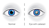 Medscheme sets up network aimed to reduce costs of cataract procedures 
